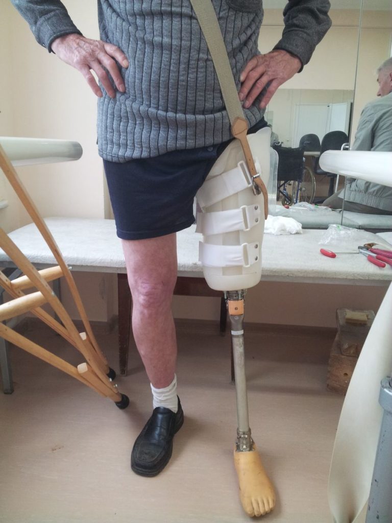 Протезирование культи бедра