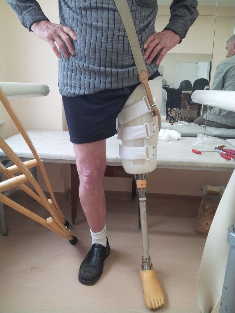 Протезирование культи бедра