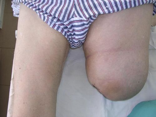 Отёк культи