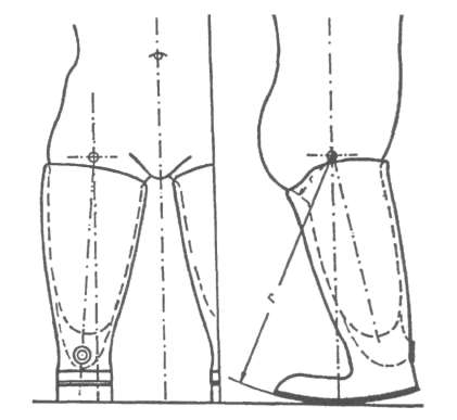 Короткие протезы после двусторонней ампутации бедра