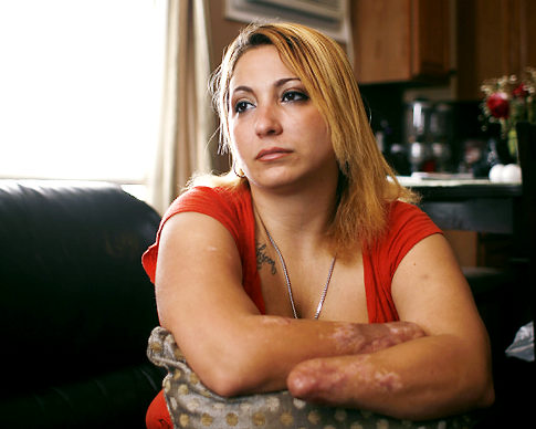 Женщина, которая дважды потеряла руки, проявляет стойкость