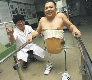 Мужчина, которому ампутировали половину тела, удивляет хирургов своей жизнеспособностью