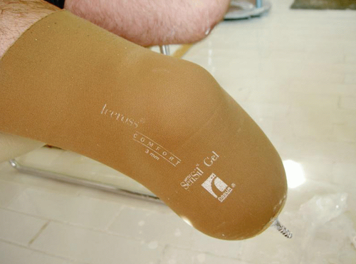 Протезирование при сахарном диабете