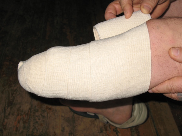 Процесс реабилитации, подготовка к использованию протеза