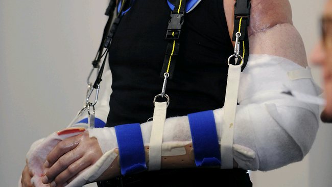 Хирурги выполнили первую в мире тройную пересадку конечностей