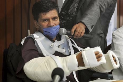 В Мексике успешно прошла 17-часовая операция по одновременной пересадке обеих рук