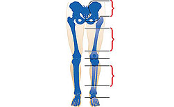 Виды ампутации