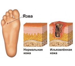 Диабетическая стопа. Поражения ног при сахарном диабете