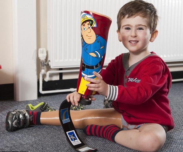 Детский протез ноги позволит ребенку-инвалиду заняться спортом