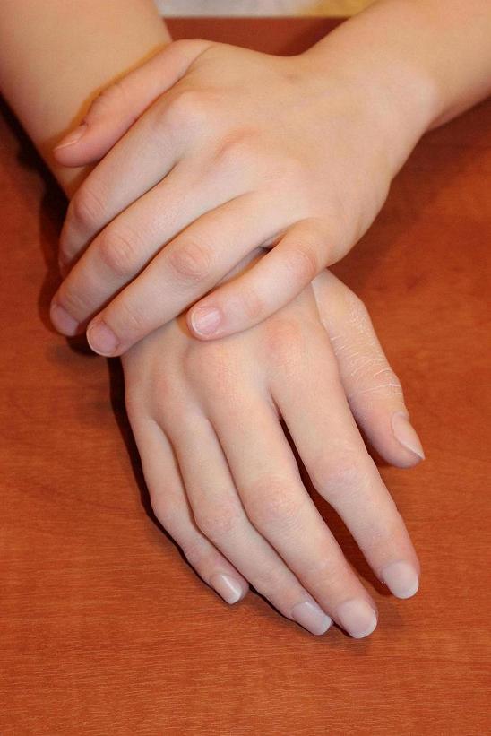 Косметические протезы рук с силиконовыми оболочками SILAB