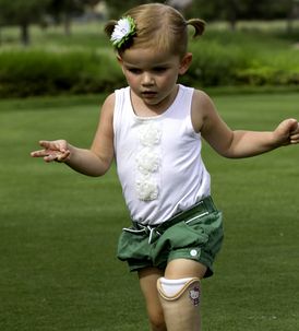 Протезирование конечностей у детей