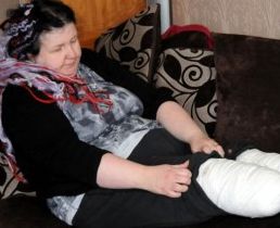 Ожирение после ампутации нижних конечностей