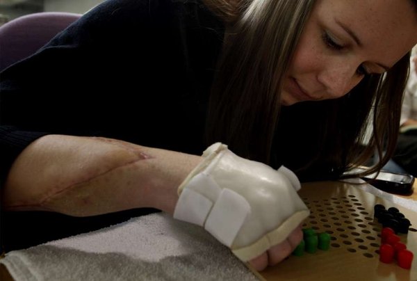 В детской больнице Бостона стартовала программа помощи безруким детям