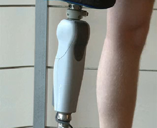 20 пациентам по всей стране будут установлены бионические протезы с искусственным интеллектом