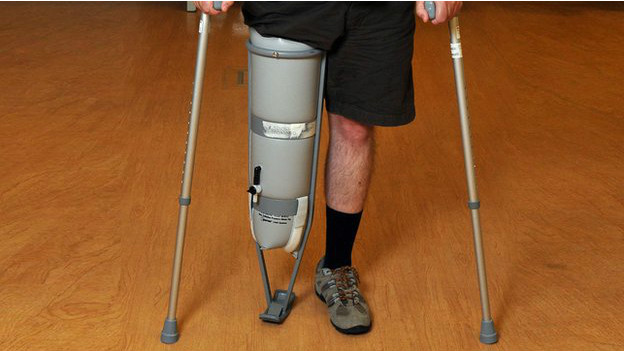 140811131422_prosthetics_bbc_leg_amputee_624x351_bbc_nocredit