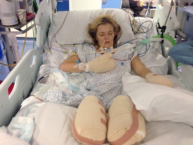 Из-за пневмонии лишилась обеих ног и пальцев рук