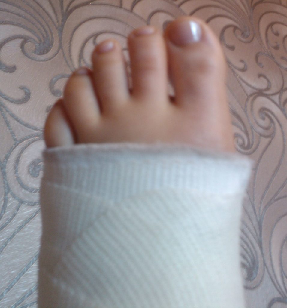 Некачественный протез, из-за которого пациентка сломала вторую ногу, стоил компании-ООО «Протезка» 139 тыс. руб.