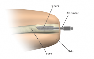 В США одобрены протезы, которые вживляются в кость пациента