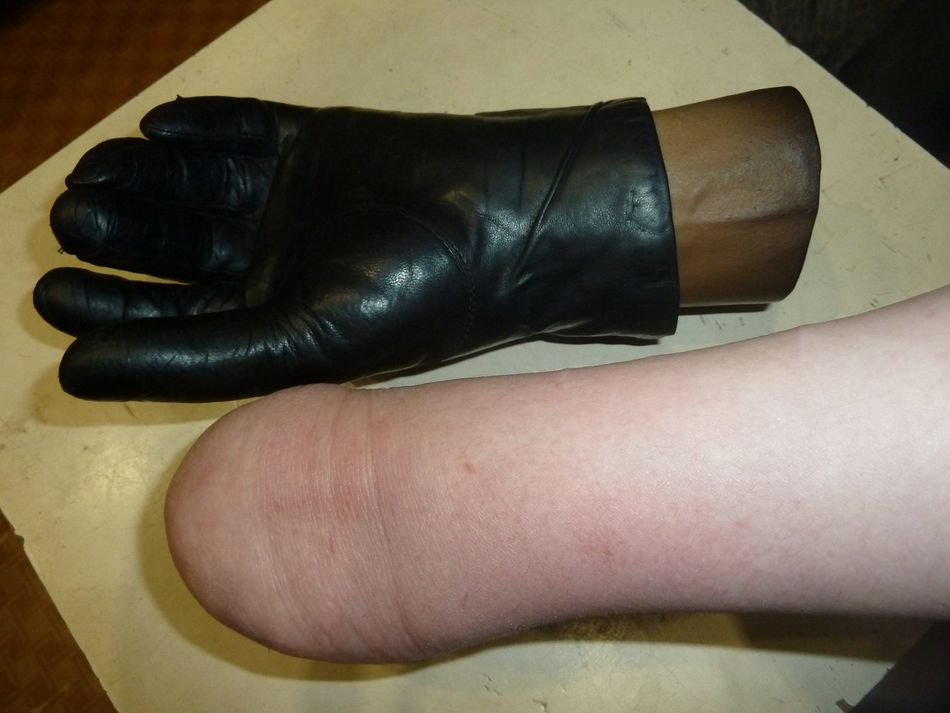 протез руки