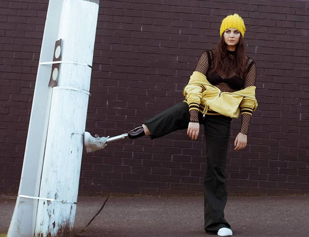 Девушка перестала скрывать протез ноги