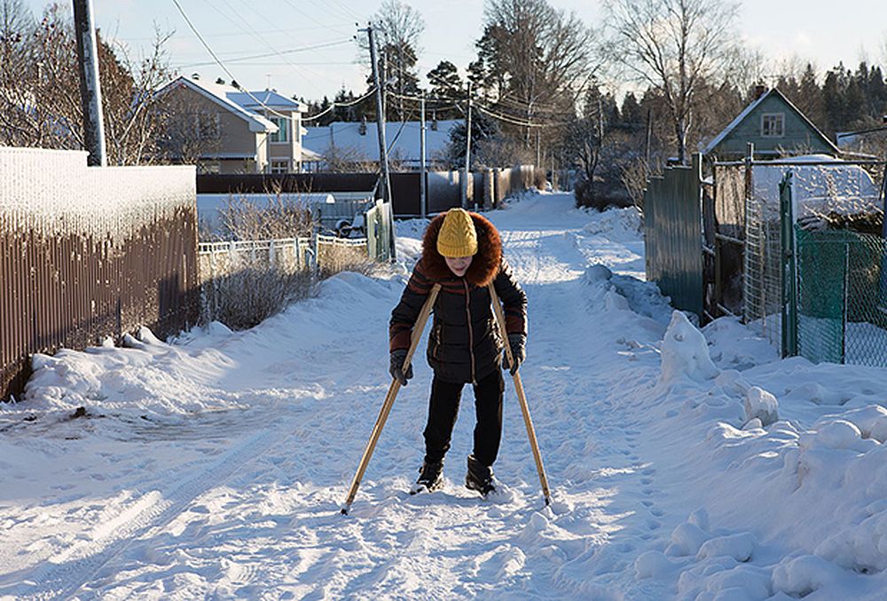 От мучений Василину смогут избавить специальные модульные протезы, в которых она будет ходить без слез и боли