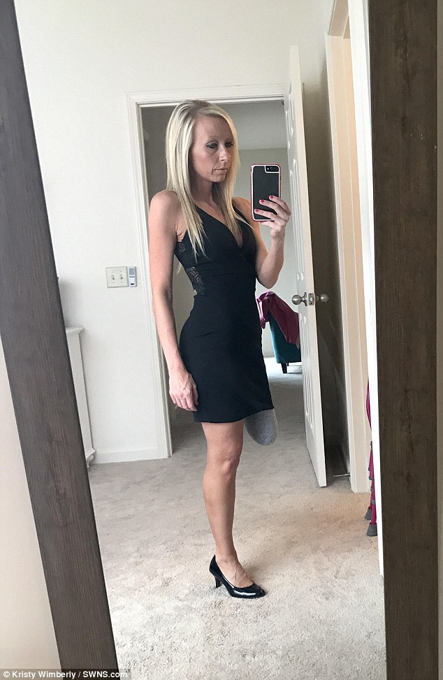 Женщина ампутировала свою уродливую ногу, которую прятала 20 лет