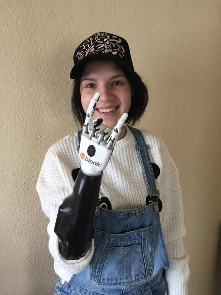 Рите Грачёвой изготовили функциональный протез Bebionic