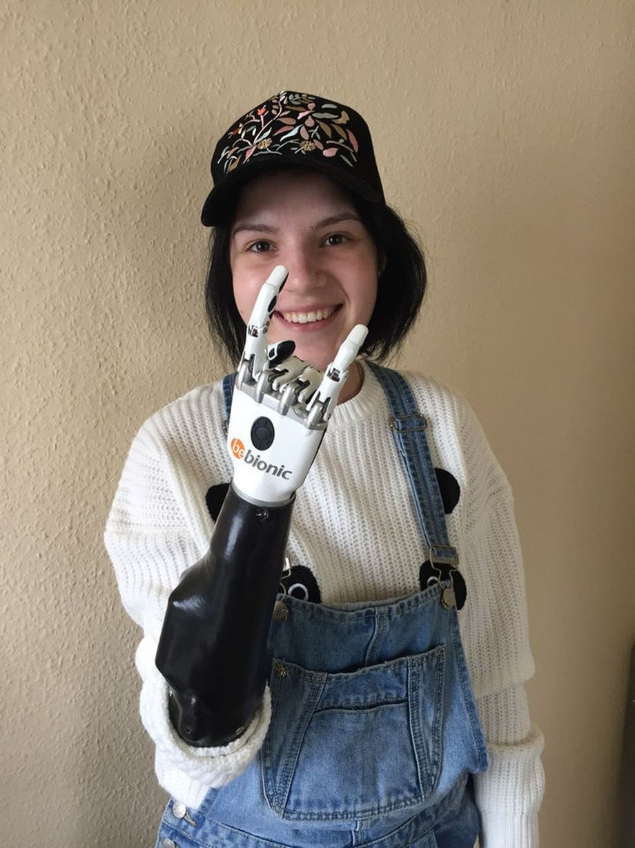 Рите Грачёвой изготовили функциональный протез Bebionic