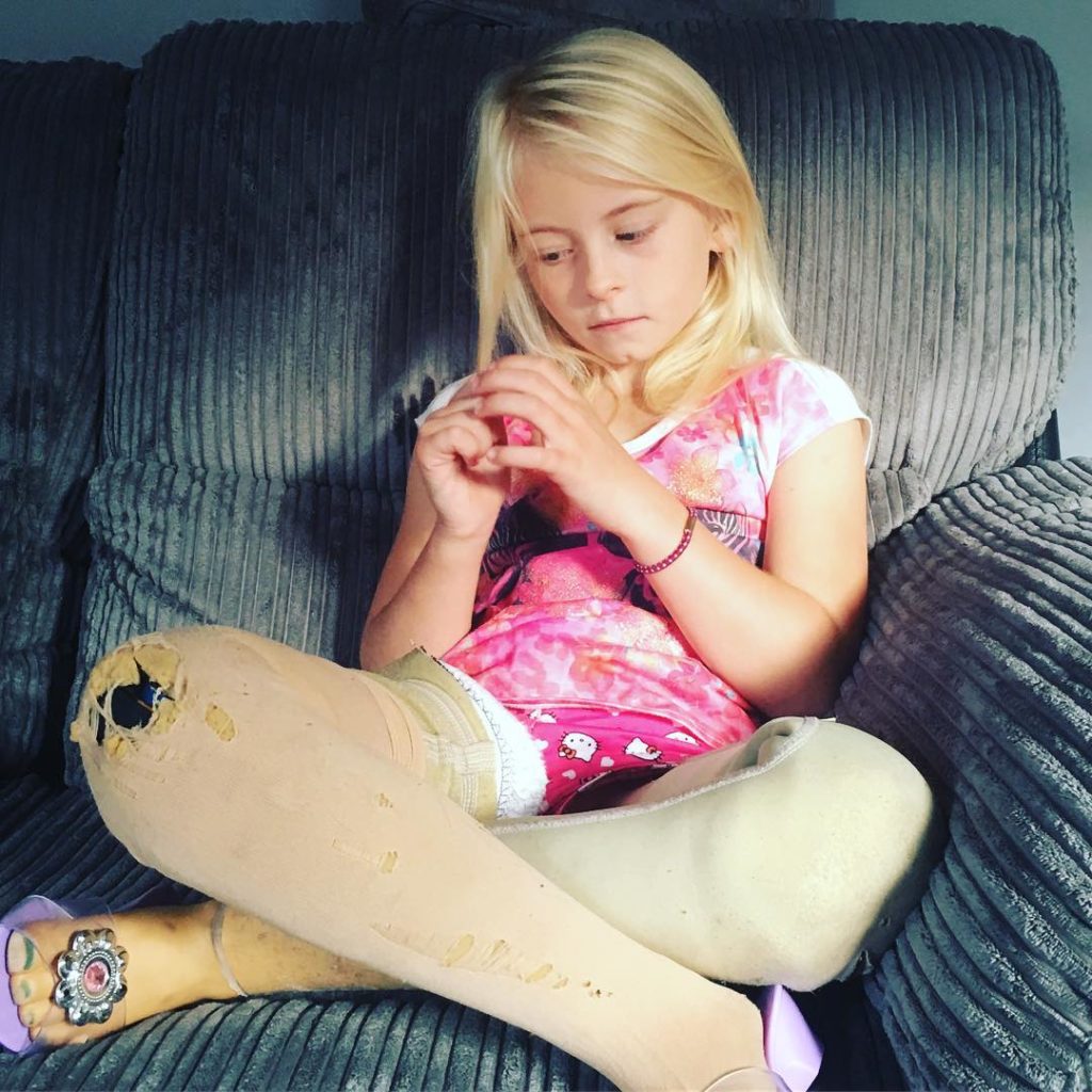 7-летняя девочка с ампутированными ногами строит карьеру в модельном бизнесе