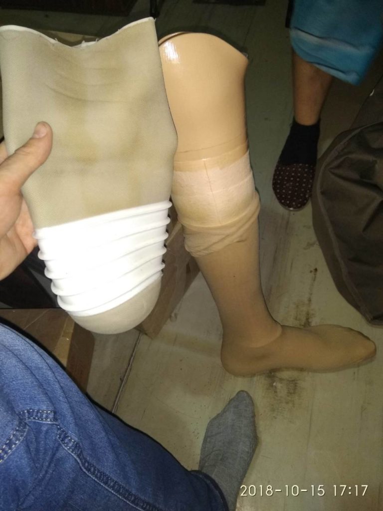 Протез левой ноги ниже колена