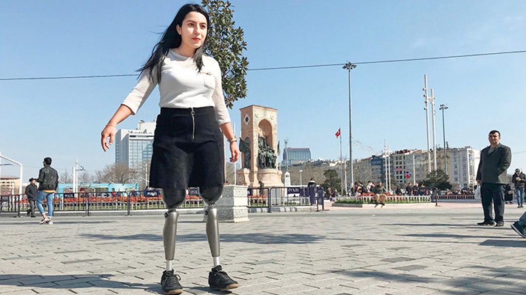 22-х летняя девушка впервые встала на ноги при помощи протезов