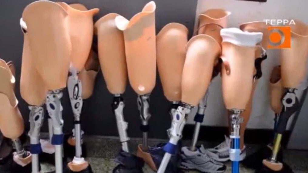 Протезы для бедных россиян