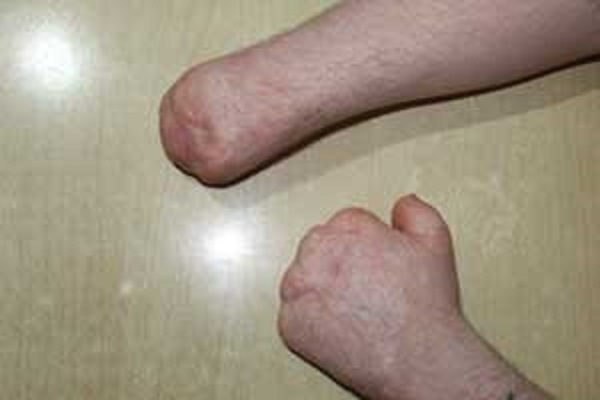 Социальная реабилитация инвалида после ампутации рук