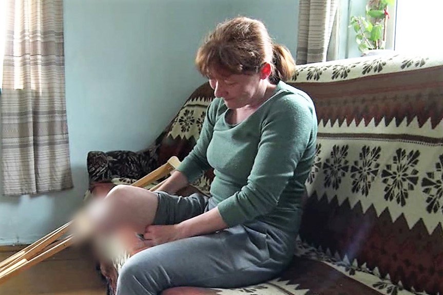 Многодетной матери по ошибке ампутировали ногу и не дали инвалидность