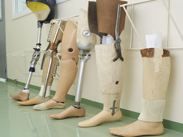 29-летней женщине отказались менять износившейся силиконовый чехол протеза