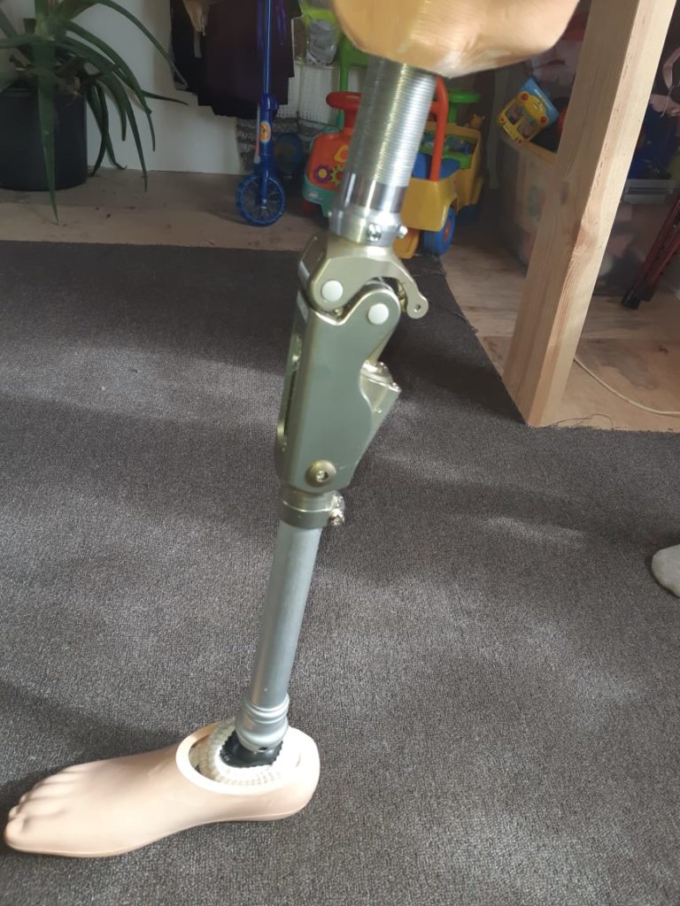 Новый протез ноги выше колена