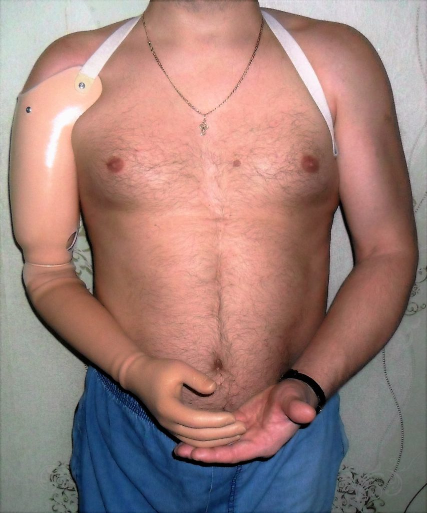 Протез правой руки