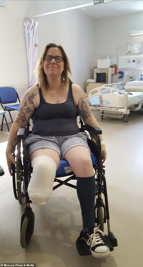 Симптомы после ампутации ноги