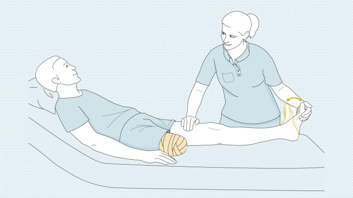 Отёк культи