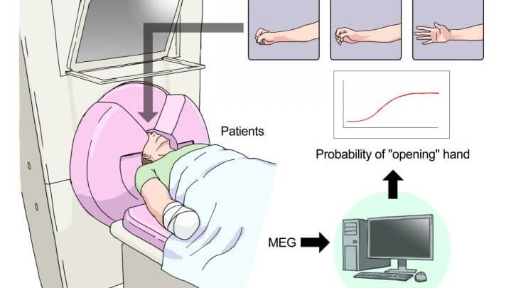 Фантомные боли в конечностях уменьшаются благодаря силе мозга