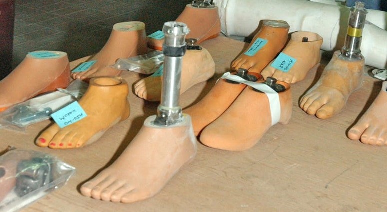 Протезы конечностей