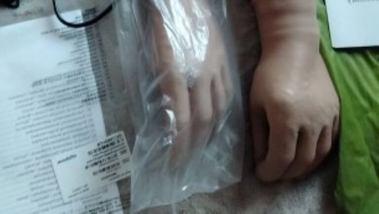 Продам протез верхней правой конечности