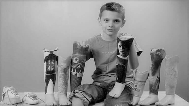 Детские протезы ног