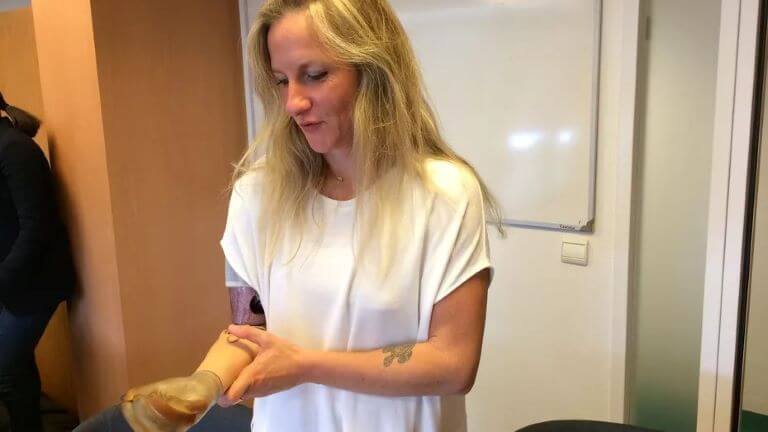 Присилль Дебора с ампутированной правой рукой