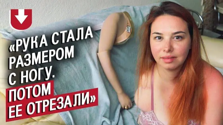 Мне отрезали руку
