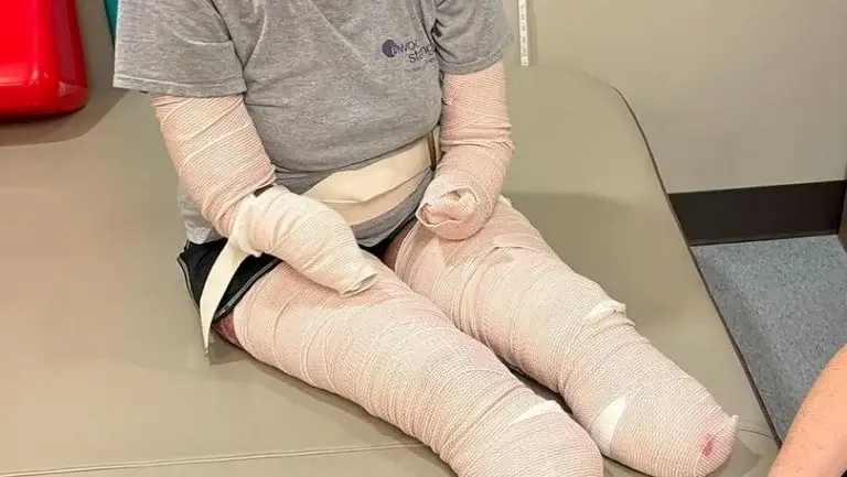 Ампутация от Ковида