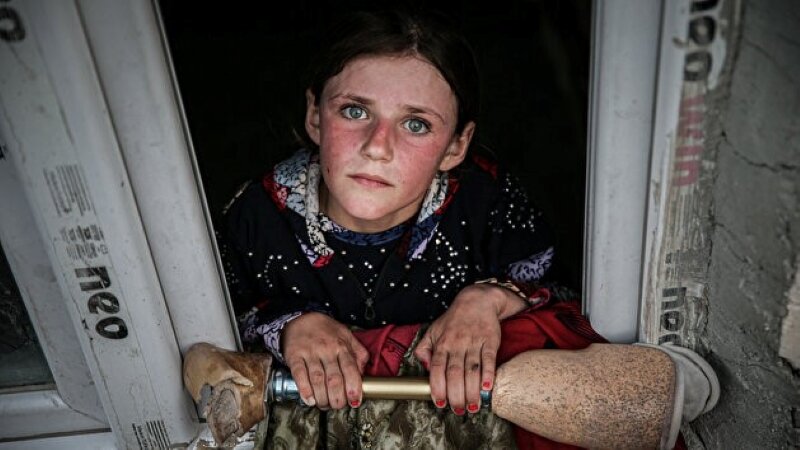 Сирийская девочка мечтает о протезе ноги