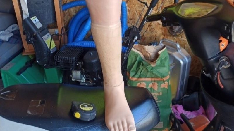 Протезы голени обеих ног