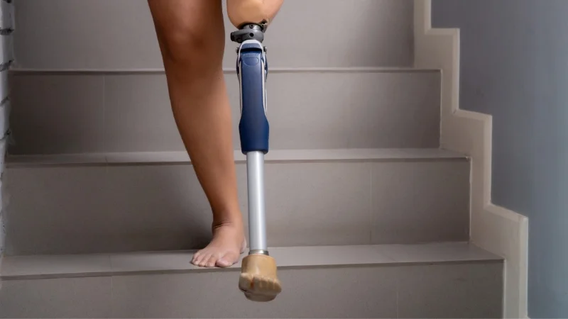 Реабилитация после ампутации конечностей