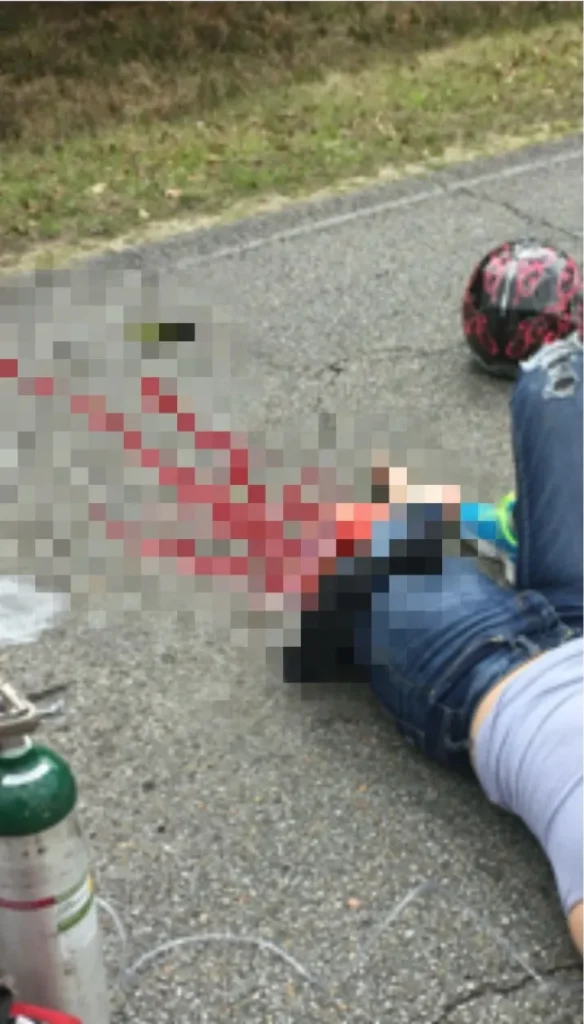 Бедренная кость Тейлор сломалась пополам, когда она попала в аварию с автомобилем, ехав на мотоцикле